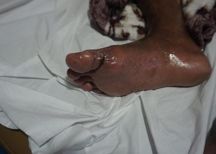 Jemaah Dengan Komorbid Diabetes, Gunakan Alas Kaki Yang Tepat