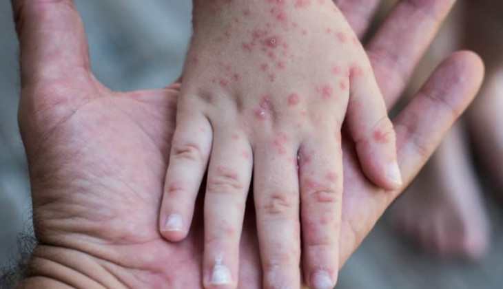 Pembatasan dan Transportasi Hewan dari Daerah Endemik Cacar Monyet Perlu Dilakukan